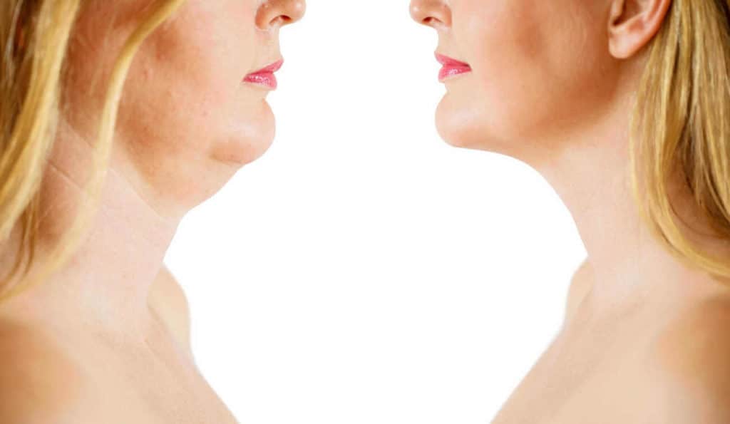 Double Chin treatment Tulse Hill before and after results