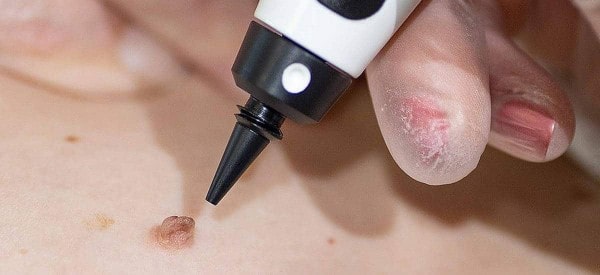 After Skin Tag Removal Tulse Hill