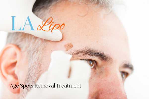 What Are the Most Effective Treatments for Age Spots Tulse Hill?