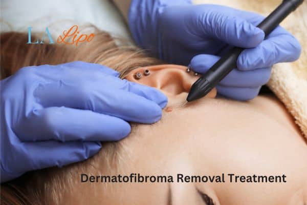 Dermatofibroma Removal Treatment Tulse Hill