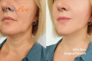 hi-fu for wrinkles Tulse Hill before and after results