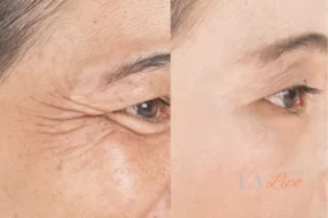 Before and after results of woman - HI-fu wrinkles reduction treatment Tulse Hill