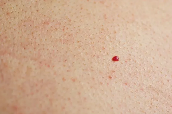 close up of a cherry angioma Tulse Hill