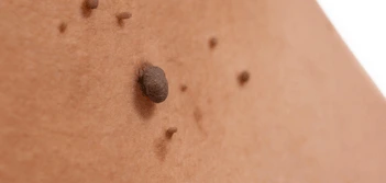 image of a skin tag Tulse Hill