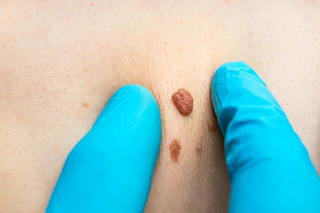 Consultant examining a skin tag Tulse Hill