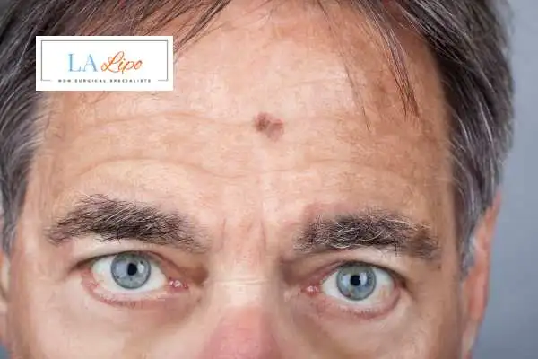 Solar Lentigo Removal Tulse Hill image of man with mark on his forehead