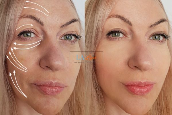 Morpheus 8 results Tulse Hill face lift.