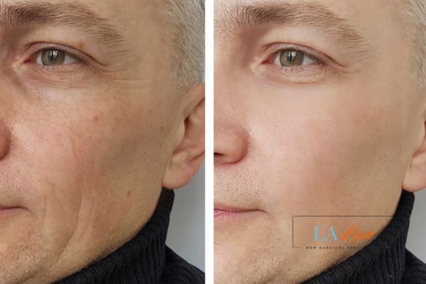 See the amazing results of Morpheus8 Treatment Tulse Hill!