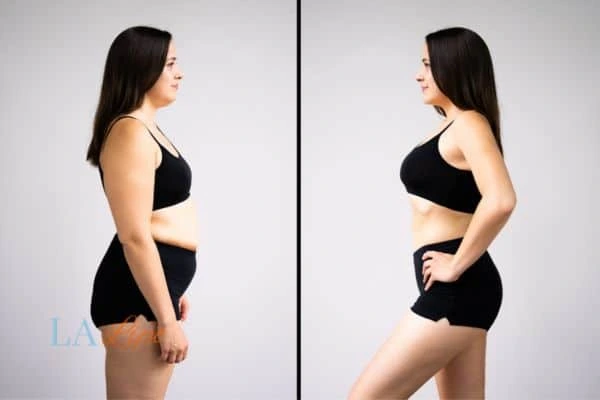 Picture of womans before and after using LA-EMS body sculpting to improve her core strength Tulse Hill