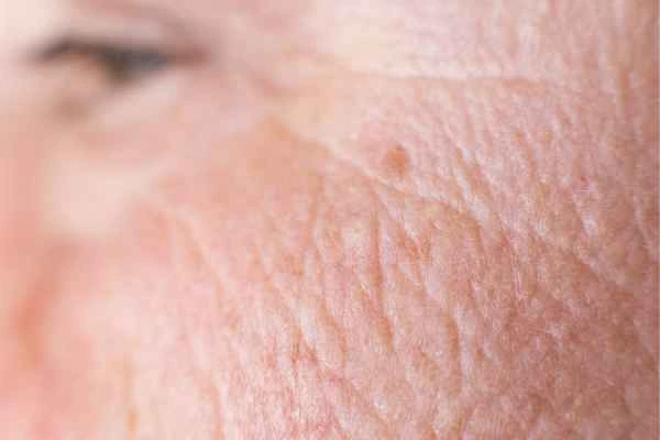 close up picture of a woman's face showing an age spot Tulse Hill