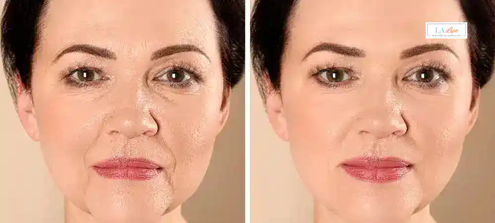 How Long Does It Take to See Results and How Long Do They Last Tulse Hill?