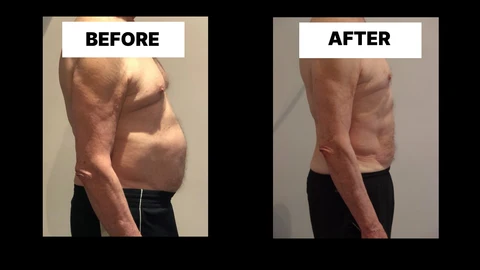 What Symptoms Can Diastasis Recti Cause in Men? Weak Core, Back Pain and Poor Posture Tulse Hill
